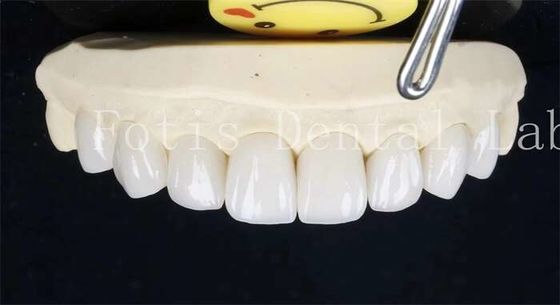 0.3-0.5mm gốm niêm mạc răng răng giả veneers với xi măng gắn kết gắn kết