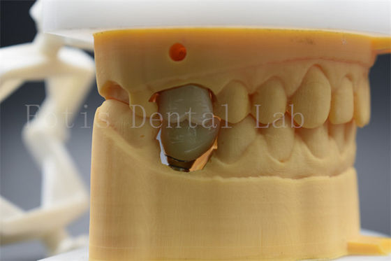 Nhập răng tùy chỉnh Abutment vương miện thoải mái cho bệnh nhân