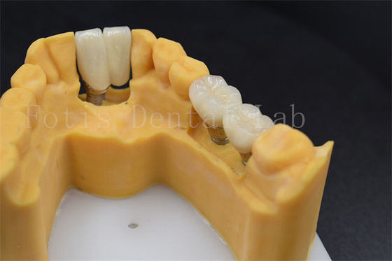 Phục hồi răng tùy chỉnh Cấy ghép thay vương miện Nhiều kích thước