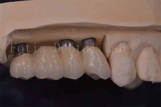 Chế độ phù hợp chính xác Vương miện cấy ghép răng Titanium / Zirconia / PFM phục hồi răng bị thiếu