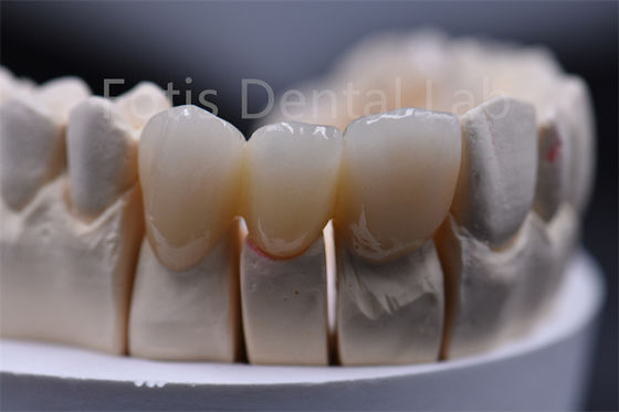 Chất liệu nha khoa gốm Zirconia nhiều lớp có thể tùy chỉnh
