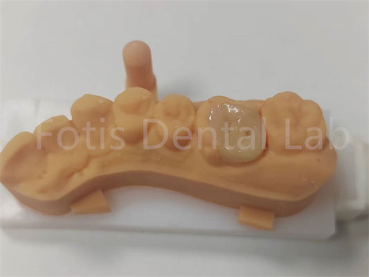 Việc phục hồi răng để giữ lâu