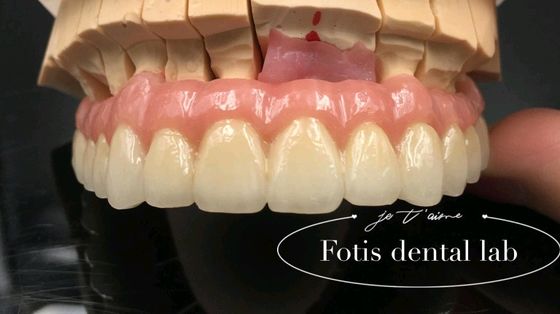 Phục hồi đáng tin cậy PFM vương miện răng sứ hợp nhất với vương miện kim loại tùy chỉnh