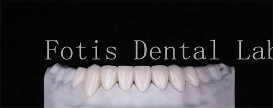 Độ bền cao Các veneer răng trông tự nhiên Độ dày 0.3mm-0.5mm