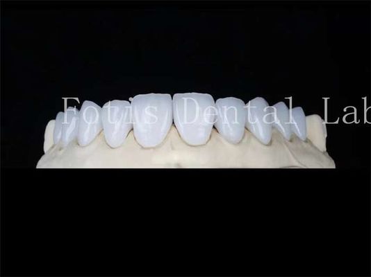 Tùy chỉnh Porcelain tự nhiên veneers nha khoa phòng thí nghiệm veneers chống vết bẩn