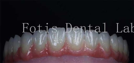 bề mặt mịn mượt trang trí răng mỹ phẩm veneers sứ tự nhiên tùy chỉnh