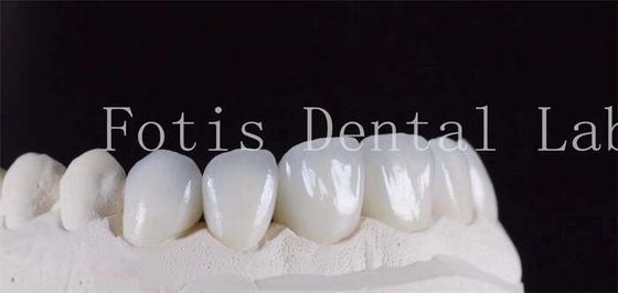 Ultra Strong Translucent Dental Laminate Veneers Màu tự nhiên