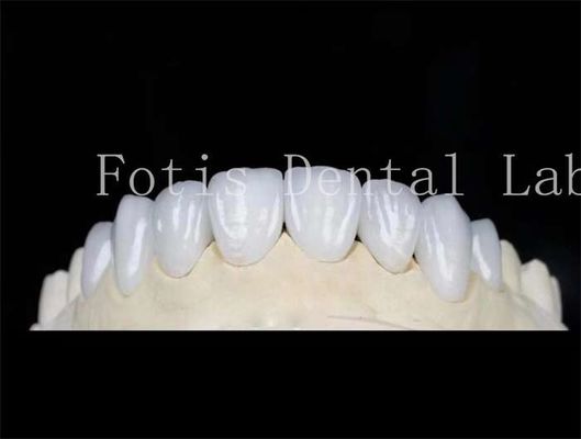Đèn mài răng màu tự nhiên Đèn mài răng giả với xi măng gắn kết