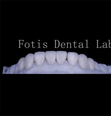 Long Lasting Smooth Texture Teeth Cover Veneers Veneer răng tự nhiên