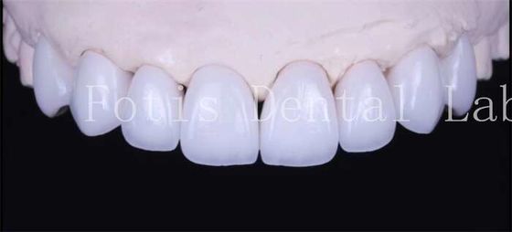 Xi măng gắn kết tự nhiên màu trắng với độ mờ cao
