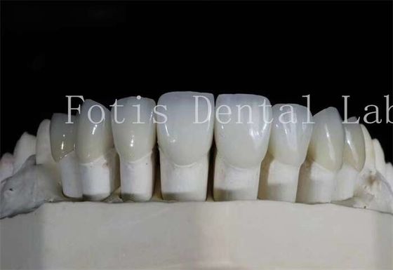 Laminate răng đánh bóng veneers xuyên suốt cao cho nụ cười trông tự nhiên