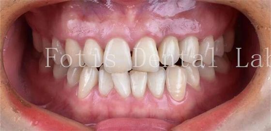 Vệ phẩm nha khoa Vệ phẩm sứ nha khoa có khả năng chống vết bẩn cao