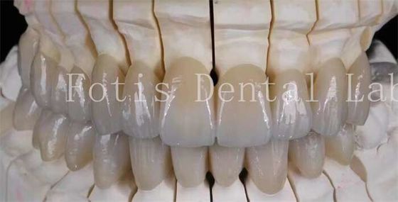 Nụ cười trông tự nhiên Xương giả sứ Laminate Veneers bề mặt mịn