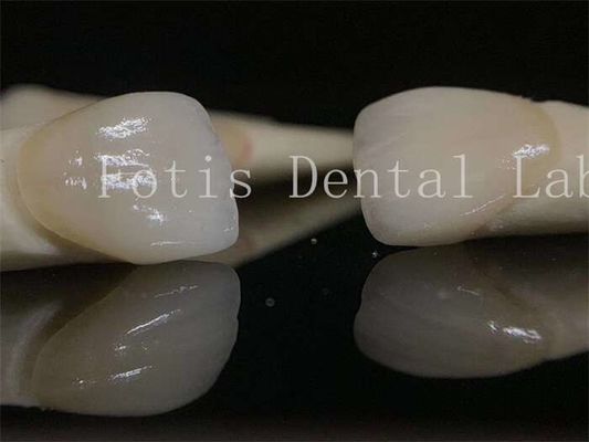 Laminate veneers phòng thí nghiệm nha khoa lâu dài có thể tùy chỉnh cho các chế phẩm răng khác nhau
