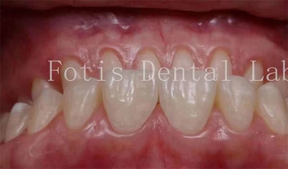 0.3-0.5mm Độ dày răng mỹ phẩm bao gồm veneers cho nha khoa mỹ phẩm