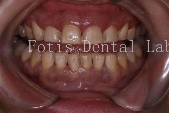 Tùy chỉnh veneers răng sứ với kết cấu bề mặt mịn