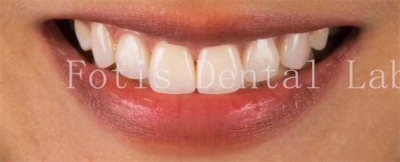 Các veneer răng thẩm mỹ cao cấp để chống vết bẩn nụ cười hoàn hảo