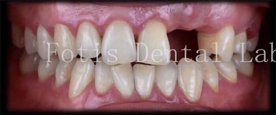 Các miếng veneer răng tạm thời tự nhiên tùy chỉnh cho nụ cười đẹp