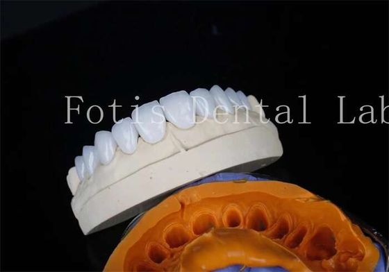 Đồ xốp nha khoa phòng thí nghiệm veneers Bonding xi măng cho phục hồi lâu dài