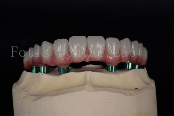 Titanium/Zirconia lâu bền Tất cả trên 4/6 cấy ghép Bảo trì dễ dàng Tỷ lệ thành công cao