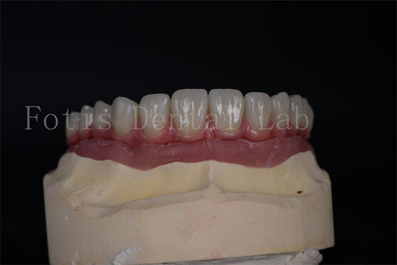 Vẻ đẹp tự nhiên với giá cả phải chăng Tất cả trên 4 Tất cả trên 6 cấy ghép