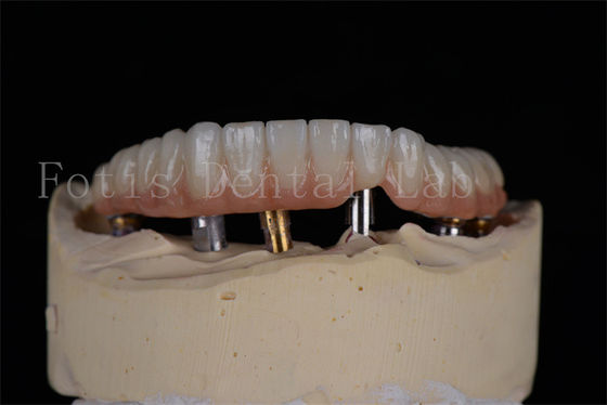 Giá cả phải chăng Nhìn tự nhiên 4 hoặc 6 cấy ghép Full Arch Tỷ lệ thành công Giải pháp xâm lấn tối thiểu