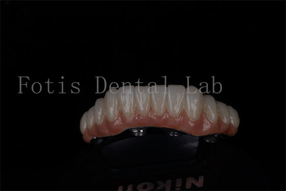 Phục hồi toàn bộ miệng tất cả trên 4 và tất cả trên 6 Titanium hoặc Zirconia Tỷ lệ thành công cao