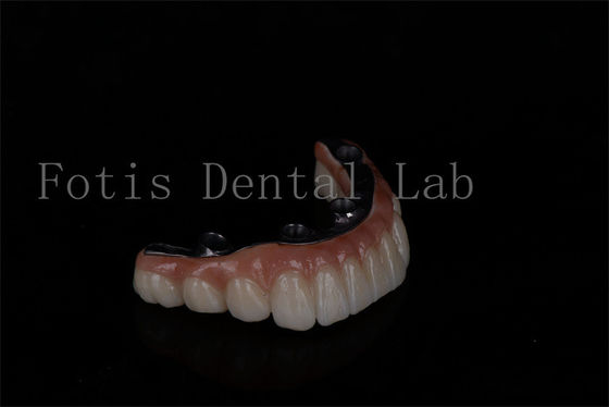 Không giới hạn tuổi có giá cả phải chăng Tất cả trên 6 cấy ghép Zirconia Bảo trì dễ dàng