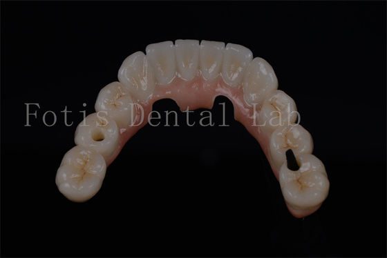 Nhìn tự nhiên tất cả trên bốn răng trong một ngày cho mọi lứa tuổi có sẵn