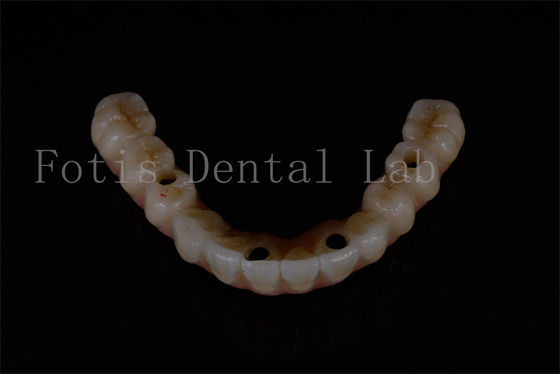 Thay thế tất cả trên 4 tất cả trên 6 cấy ghép răng tiên tiến cho chức năng tối ưu