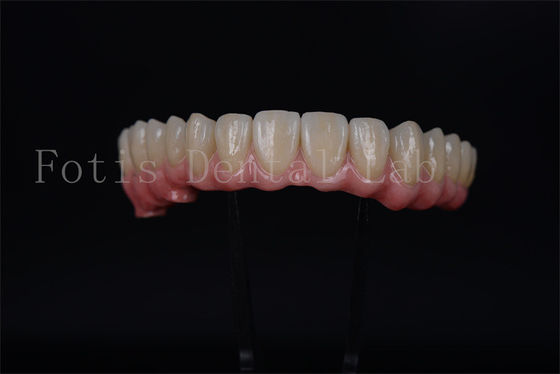 Full Arch Implant Bridge Tất cả trên 4 Tất cả trên 6 Để phục hồi răng hoàn toàn