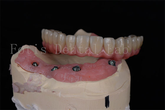 Tùy chỉnh tất cả trên 4 tất cả trên 6 cấy ghép răng để phục hồi chức năng răng miệng hoàn chỉnh