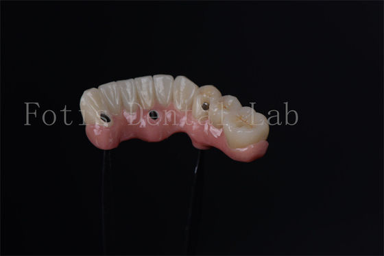 Cá nhân Tất cả trên 4 Tất cả trên 6 cấy ghép nội xương để thay thế răng ngay lập tức
