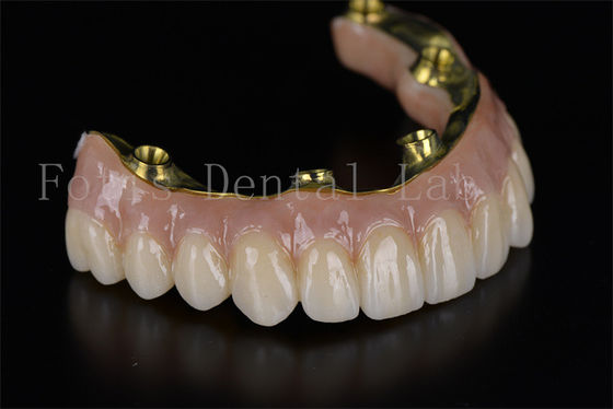 Xây dựng lại toàn bộ miệng tất cả trên 4 tất cả trên 6 hệ thống cấy ghép răng