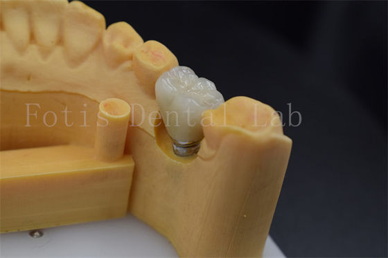 Dễ dàng đặt và điều chỉnh cấy ghép giữ vương miện xử lý bề mặt đánh bóng