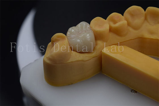 Titanium / PFM Vương miện răng giả có thể tùy chỉnh Zirconia Implant Crown bền