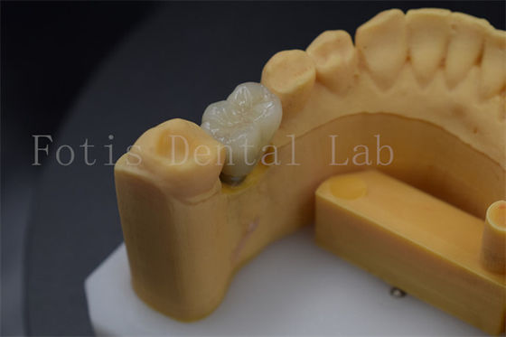 Vương miện cấy ghép răng thoải mái lâu dài để phục hồi răng bị mất