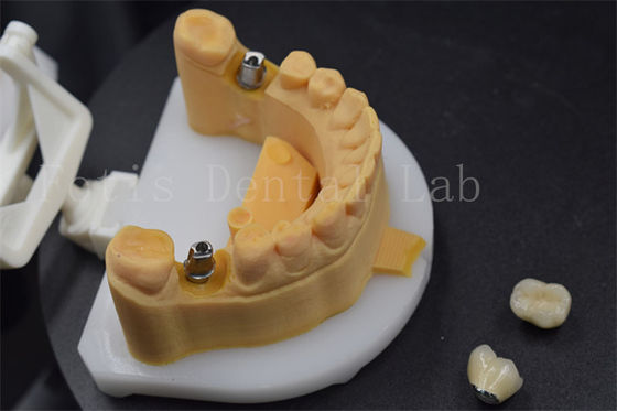 Dễ dàng đặt Zirconia răng vương miện Titan vương miện cho răng tùy chỉnh