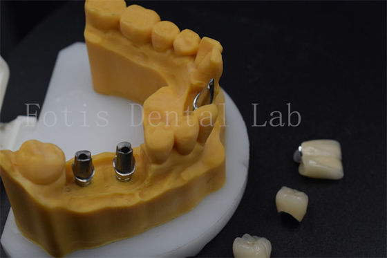 Cao độ bền răng cấy ghép vương miện dễ điều chỉnh răng cấy ghép hướng dẫn tay áo