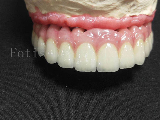 Titanium / Zirconia Implant Crown Polished Finish Vương miện răng giả