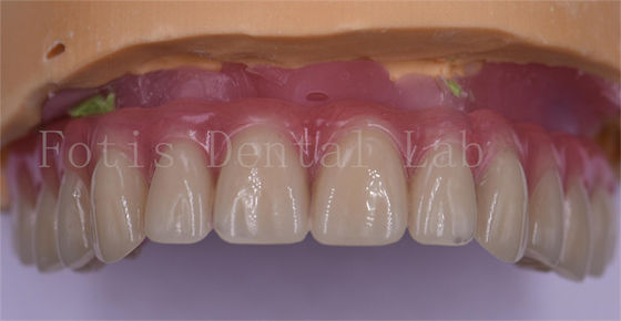 Khá tiện cho bệnh nhân Vương miện nha khoa tùy chỉnh Titanium/Zirconia/PFM được đánh bóng