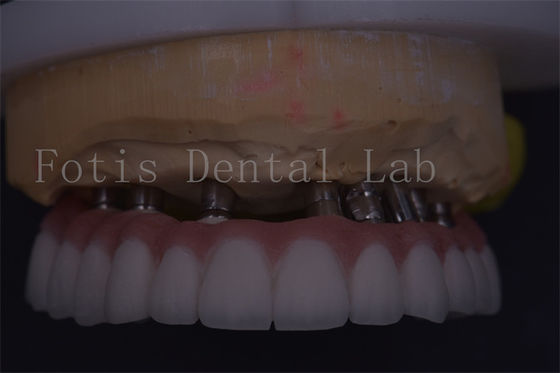 Đơn vị hóa vàng vương miện răng chính xác phù hợp cho phục hồi thoải mái