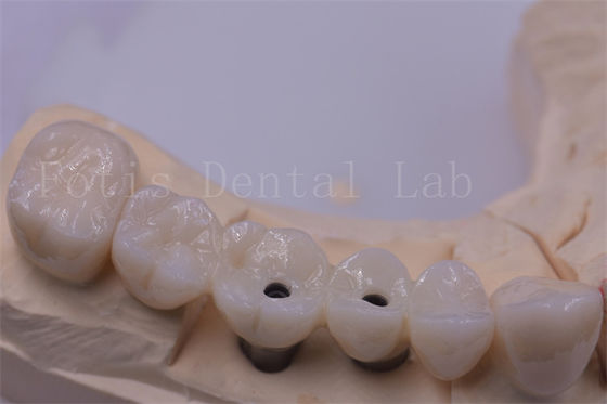Titan / Zirconia Vương miện răng bạc đánh bóng cho răng bị thiếu
