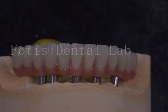 Vương miện cấy ghép răng tùy chỉnh cho vẻ ngoài tự nhiên và phục hồi thoải mái