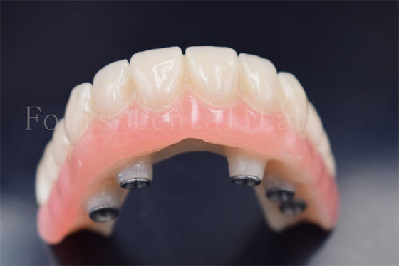 Nhập răng tùy chỉnh Vương miện thay thế chống mòn