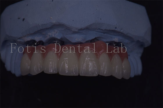 Vương miện cấy ghép răng được chế tạo chính xác cho tuổi thọ và sự thoải mái vượt trội