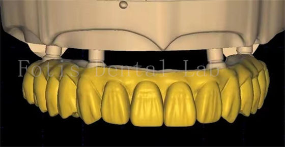 Thiết kế vương miện răng OEM sử dụng công nghệ quét và in 3D tiên tiến