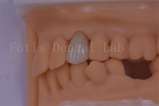 3 Hình dạng / thiết kế ngoại hình Vương miện nha khoa kỹ thuật số phù hợp hơn và ít khó chịu hơn