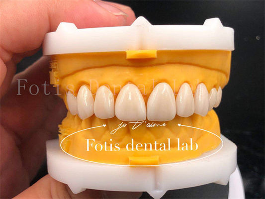 Nhanh và hiệu quả Vương miện nha khoa kỹ thuật số kích thước tùy chỉnh Vương miện cấy ghép răng