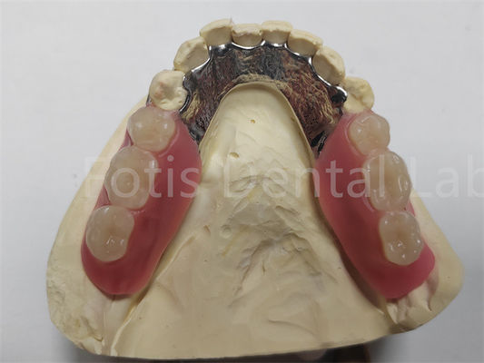 OEM Denture linh hoạt có thể tháo bỏ một phần dễ làm sạch / bảo trì